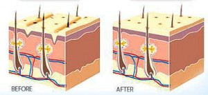 How collagen restores the skin