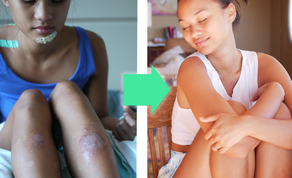 get rid of eczema, eczema on skin, eczema rash, excema